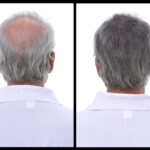 Are You a Good Candidate for a Hair Transplant? Key Factors to Consider