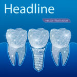 Unraveling Dental Implants
