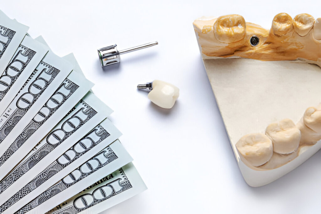 Breaking Down the Cost of Dental Implants