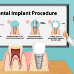 Step-by-Step Guide to Getting Dental Implants