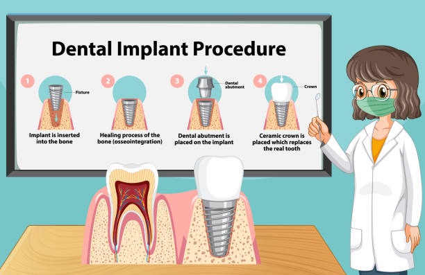 Step-by-Step Guide to Getting Dental Implants