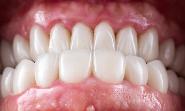 Full-Mouth Restoration