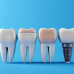 Temporary Tooth Replacements