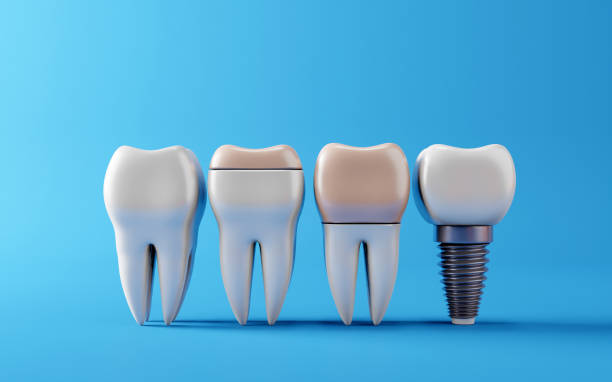 Temporary Tooth Replacements