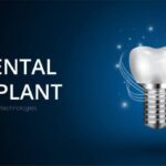 Understanding Dental Implants Cost