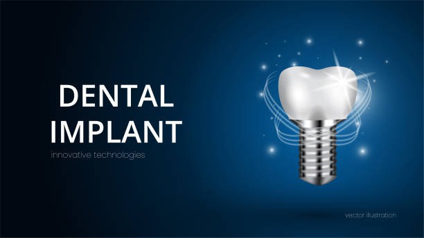 Understanding Dental Implants Cost
