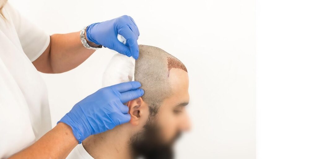 FUE Hair Transplant Procedures