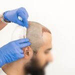 FUE Hair Transplant Procedures