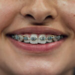 Composite Bonding Newcastle and Dental Implants Newcastle