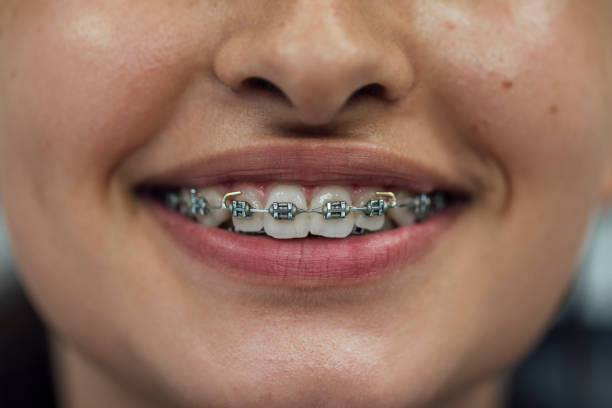 Composite Bonding Newcastle and Dental Implants Newcastle