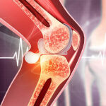 Strengthening Joints